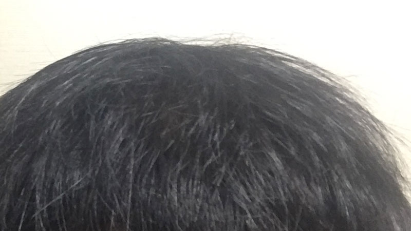 頭頂部